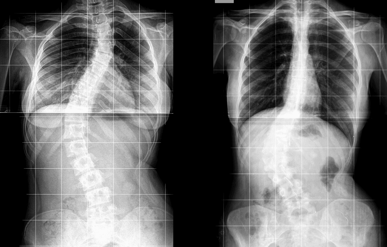 Omurga ve Skolyoz Açı Ölçümleri